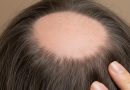 Alopecia: falhas no cabelo e fatores como estresse ou nutrição podem piorá-la Alopecia: falhas no cabelo e fatores como estresse ou nutrição podem piorá-la