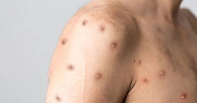 Ministério da Saúde registra 88 casos de mpox no Brasil em 2026 Ministério da Saúde registra 88 casos de mpox no Brasil em 2026